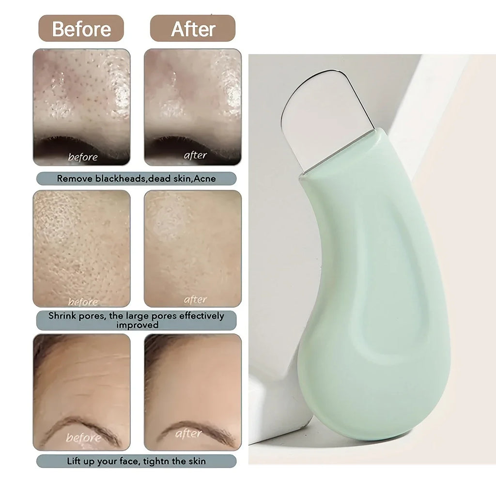 Removedor de Puntos Negros con Succión | Limpieza Profunda de Poros | Blackhead & Pore Vacuum Cleanser